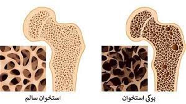 از هر 5 مرد یک نفر و از هر سه زن یک نفر احتمال ابتلا به بیماری پوکی استخوان را دارد